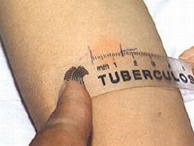 Туберкулез, фото с сайта scientific.ru
